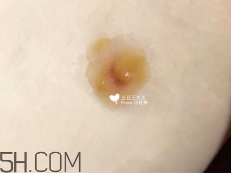 美寶濕潤燒傷膏怎么樣？美寶濕潤燒傷膏有用嗎？