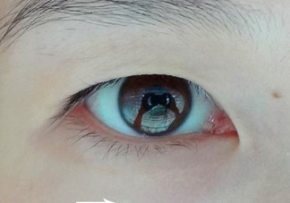 為什么會長脂肪粒？怎么消除眼睛上的脂肪粒？