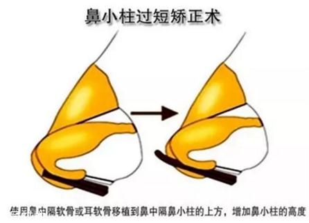 鼻小柱延長用什么材料？優(yōu)先選擇鼻中隔軟骨