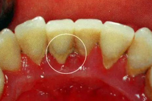 牙結(jié)石能自動脫落嗎？除了洗牙別無他法