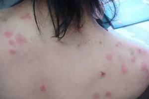 螨蟲(chóng)有哪些危害？嚴(yán)重時(shí)肌膚糜爛