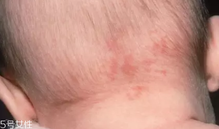 痣什么情況下會轉(zhuǎn)變?yōu)榱?？點痣不可取