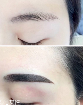 激光洗眉恢復(fù)期有疤痕怎么辦？激光洗眉毛之后正確護(hù)理方法