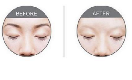 激光洗眉恢復(fù)期有疤痕怎么辦？激光洗眉毛之后正確護(hù)理方法