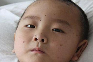 痣什么情況下會轉(zhuǎn)變?yōu)榱觯奎c(diǎn)痣不可取