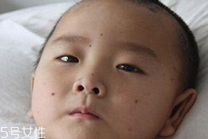 痣什么情況下會轉(zhuǎn)變?yōu)榱?？點痣不可取