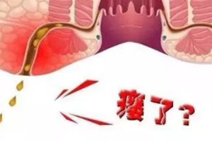 肛瘺非手術(shù)治療才可以嗎？手術(shù)是治療的關(guān)鍵途徑