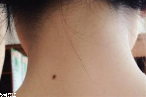 脖子后面有痣好嗎？激光冷凍祛痣易導致癌變