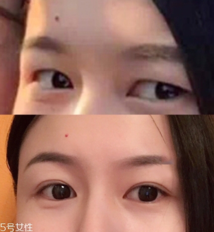 內雙怎么進化成雙眼皮？全是雙眼皮貼的功勞