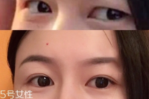 內雙怎么進化成雙眼皮？全是雙眼皮貼的功勞