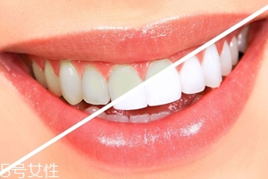 牙齒發(fā)黃是天生的嗎？只是你刷牙偷懶了