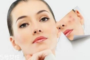 痘印多久能自行消失？多數(shù)人一年內(nèi)消失