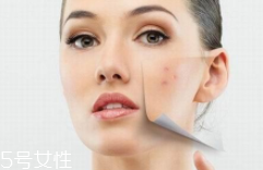 痘印多久能自行消失？多數(shù)人一年內(nèi)消失