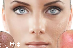 痘印多久能自行消失？多數(shù)人一年內(nèi)消失