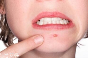 肌膚需要排毒嗎？長痘并不代表排毒