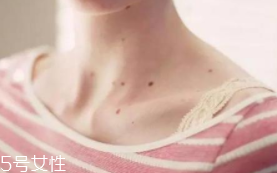 色素痣是腫瘤嗎？良性腫瘤不必?fù)?dān)心