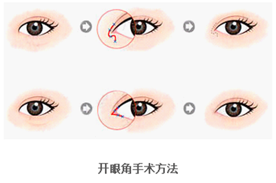 開眼角疤痕多久消失？開眼角的適宜人群