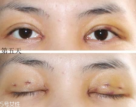 怎么縮短開眼角疤痕消失時間？雙眼皮開眼角恢復(fù)過程