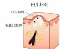 閉口是怎么引起的？4種情況要注意