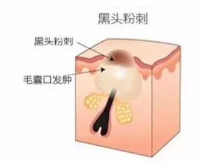 閉口是怎么引起的？4種情況要注意