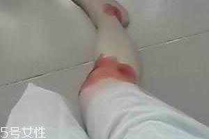 摔傷了涂什么藥好的快？做好消毒才能愈合快