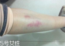 摔傷了涂什么藥好的快？做好消毒才能愈合快