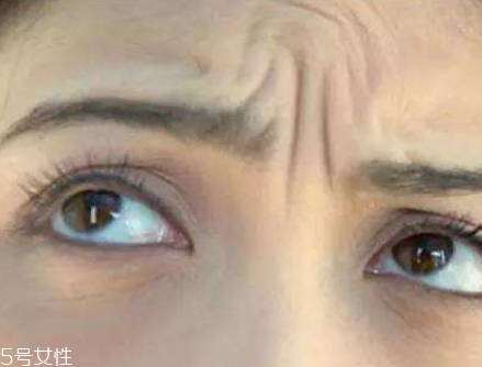 川字紋可以手術(shù)去除嗎？選擇手術(shù)需謹慎