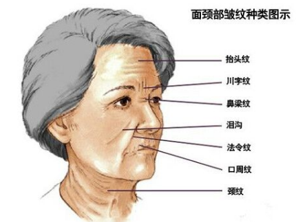 川字紋可以打玻尿酸嗎？不是最佳選擇