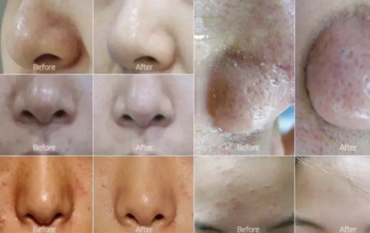 弄完小氣泡多久可以化妝？小氣泡注意事項(xiàng)