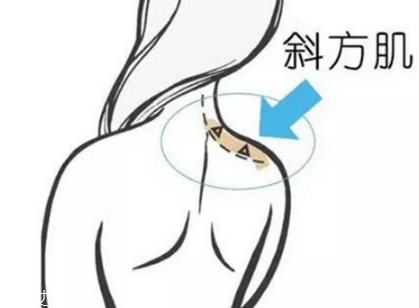 瘦肩針間隔多久打一次？打瘦肩針間隔時(shí)間