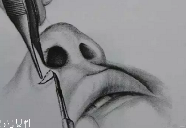 鼻翼外切多久消腫？鼻翼外切消腫時間要多長？
