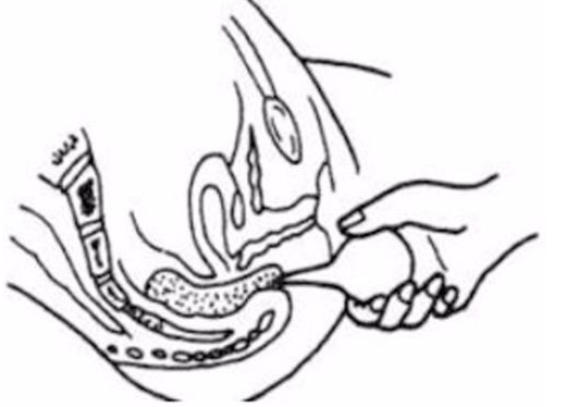 開塞露躺著還是蹲著用？開塞露使用姿勢