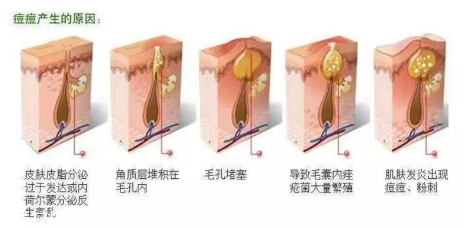 頑固痘痘怎么消除？油皮為什么反復(fù)爆痘？