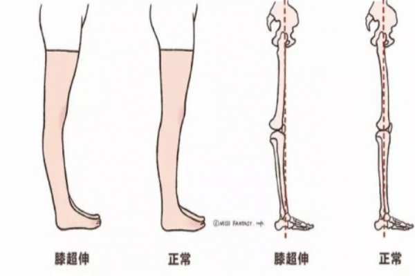 膝關節(jié)超伸的危害 會導致以下疾病