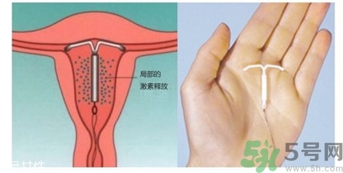 上環(huán)是什么意思？上環(huán)后注意事項(xiàng)有哪些？