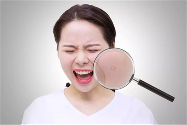 夏天臉上長(zhǎng)痘痘怎么回事 為什么夏天臉上愛長(zhǎng)痘