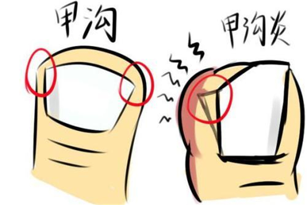 甲溝炎要拔掉整個(gè)指甲嗎 甲溝炎指甲拔了還能在長(zhǎng)出來(lái)嗎