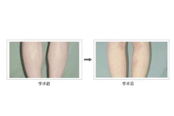 瘦腿針會導(dǎo)致靜脈曲張嗎 瘦腿針能維持多長時(shí)間
