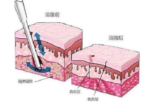 溶脂針會導致皮膚松弛嗎 溶脂針會影響月經(jīng)嗎