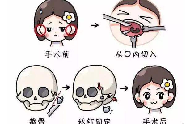 顴骨內(nèi)推和磨骨哪個風(fēng)險大 顴骨內(nèi)推的危害