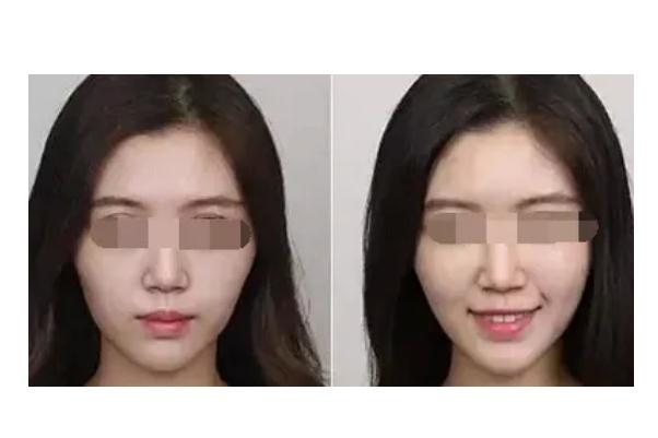 蘋果肌復(fù)位的注意事項(xiàng) 蘋果肌復(fù)位后要戴面罩嗎