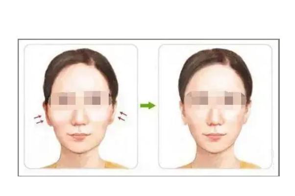 顴骨內(nèi)推和磨骨哪個風(fēng)險大 顴骨內(nèi)推的危害