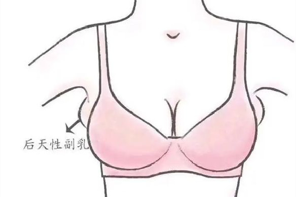 副乳切除手術(shù)是全麻還是局麻 副乳切除手術(shù)后多久可以正?；顒?dòng)