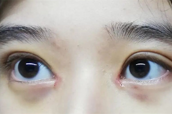 武漢開眼角最好的醫(yī)院 武漢開眼角手術一般需要多少錢