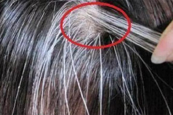 白頭發(fā)和性生活頻繁有關系嗎 白頭發(fā)是腎陰虛還是腎陽虛