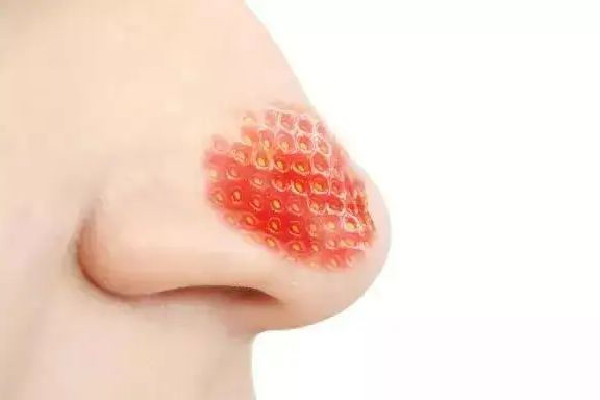 中南路skin79皮膚管理中心去黑頭去的干凈嗎 去黑頭可以用什么